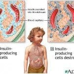 is diabetes genetic