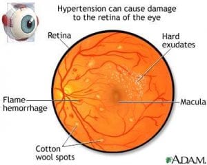 retinopathy