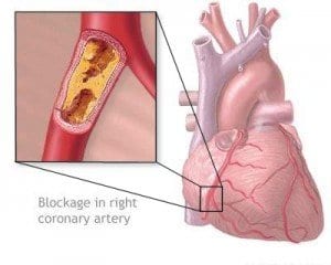 New Study Shows Diabetic Women More At Risk For CHD Over Men