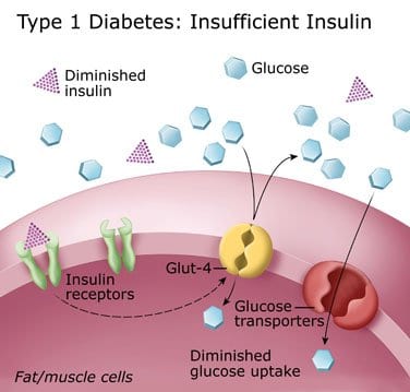 Brittle Diabetes