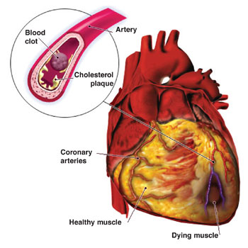 Cardiovascular Disease