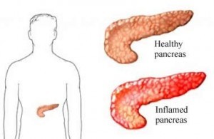 Chronic Pancreatitis