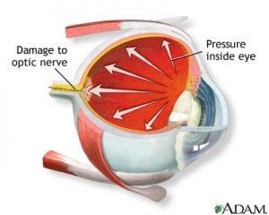 Glaucoma And Diabetes