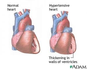 The Battle Against Diabetic Hypertension