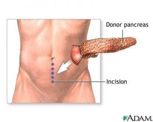 The Pancreas Transplant