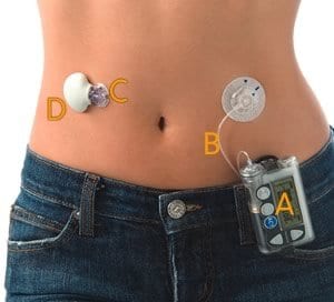 Continuous Insulin Pump