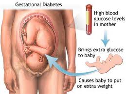 What Is Gestational Diabetes