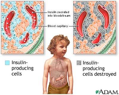 is diabetes genetic