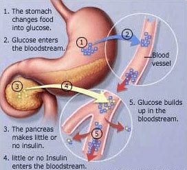 Hopes for an Artificial Pancreas Down The Road