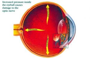 Diabetes and Hypertension Increases Risk of Open-Angle Glaucoma