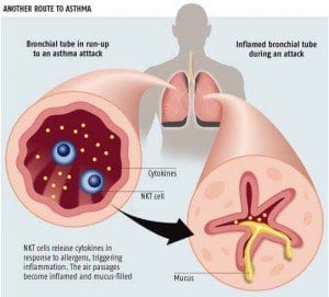 Asthma in Children May Be Linked to Poor Diabetes Management