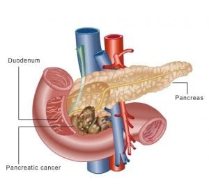 Byetta and Januvia May Be Linked to Pancreatic Cancer
