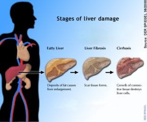 Fatty Liver Disease Associated with Elevated Risk of Cardiovascular Disease