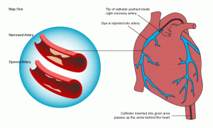 Study Analyzes Results of Angioplasties in Diabetics