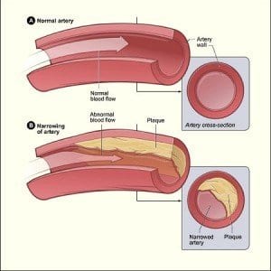 Raising HDL Cholesterol Reduces Risk of Stroke and Heart Disease