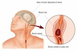 Ten-Year Diabetics at Significantly Increased Risk of Stroke