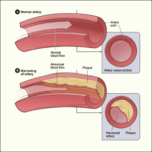 New Drugs Improve Outcome for Diabetics After Stroke