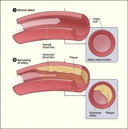 Vitamin D Helping Diabetics With Clogged Arteries