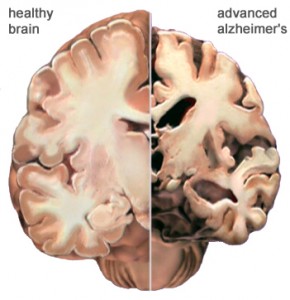 New Diabetic Study Shows Drug Can Slow Alzheimer’s Disease