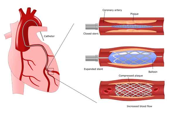 coronary heart disease study - chd