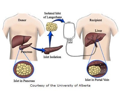 Latest Findings on Islet Cell Transplantation